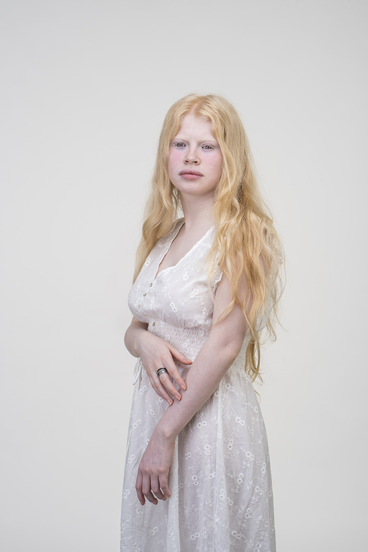ALBINOS, BEING DIFFERENT.