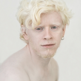 ALBINOS, BEING DIFFERENT.